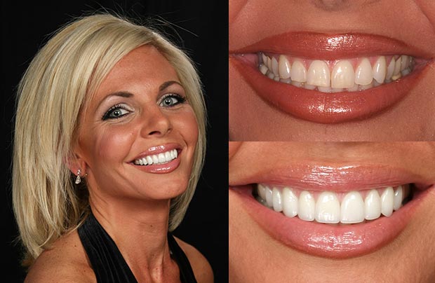 veneers teeth dental smile porcelain before makeover cosmetic dentures dentistry tooth change perfect stained shape caps skincare simple crowns laminate